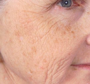 10+ Age Liver Spots Images For Early Detection