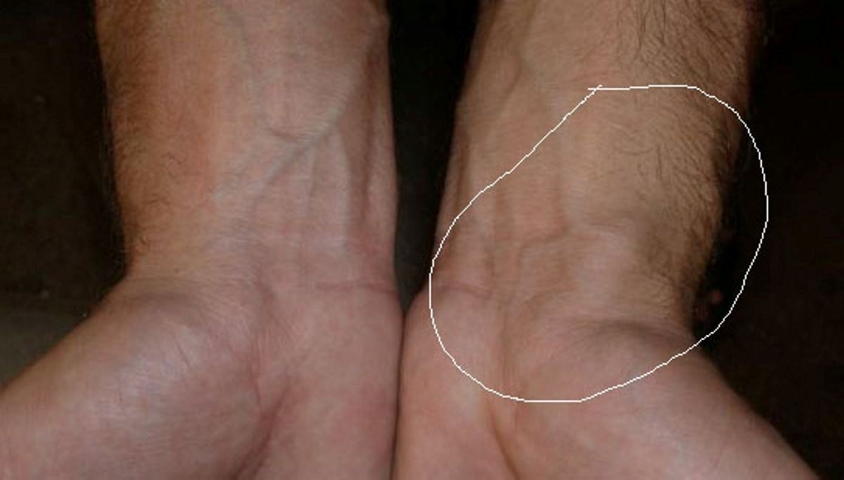 10 Blood Clot Pictures To Identify Symptoms
