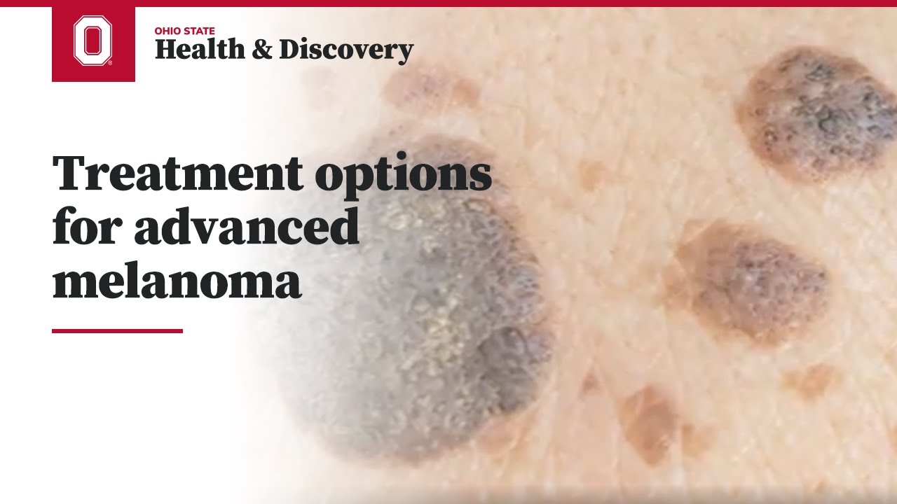 10+ Melanoma Treatment Options For Better Prognosis