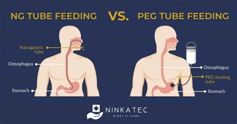 10+ Ways To Safely Remove Nasogastric Tube At Home
