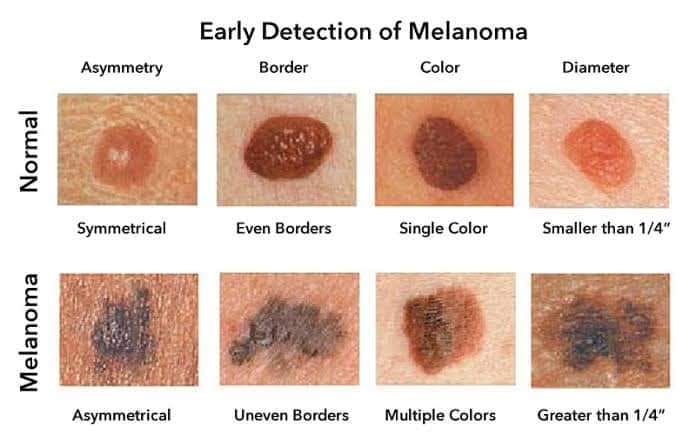 12 Canine Oral Melanoma Signs For Early Detection