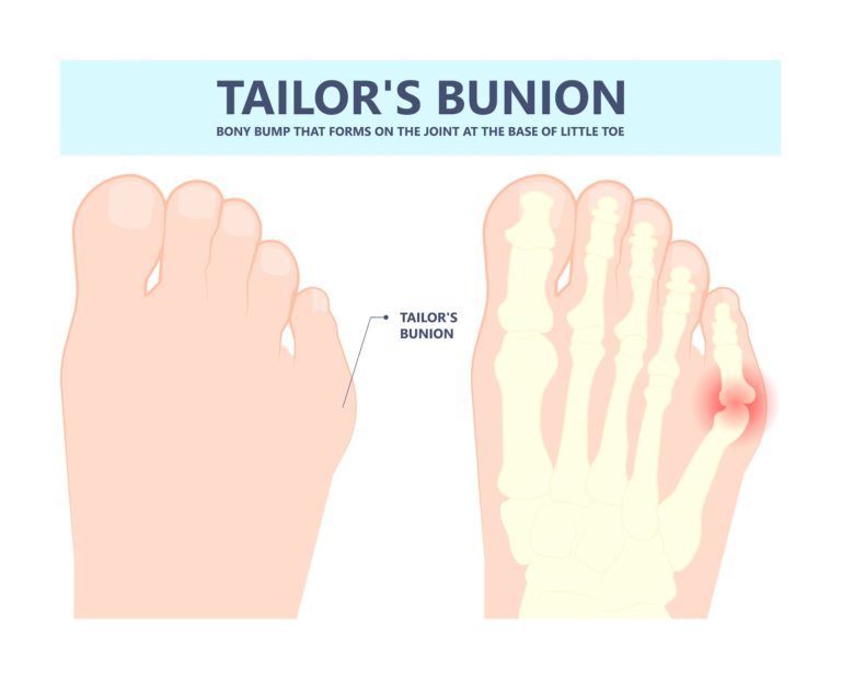 12+ Ways To Minimize Swelling After Bunion Surgery