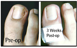 After Ingrown Toenail Surgery Problems After Ingrown Toenail Surgery Problems