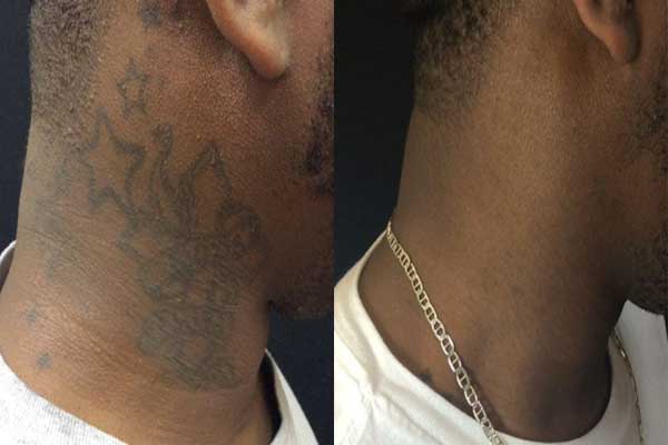 Anime Neck Tattoo: Safe Removal Options