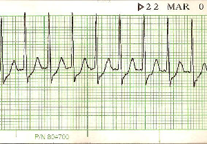 Atrial Fibrillation Vs Svt