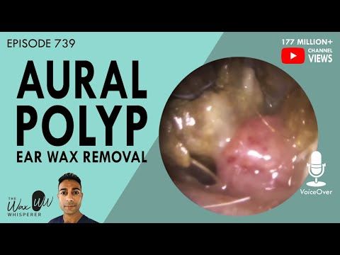 Aural Polyp