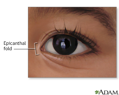 Autism Epicanthal Folds: Diagnosis And Treatment Options Autism Epicanthal Folds: Diagnosis And Treatment Options