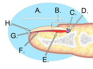 Avulsion Nail Plate