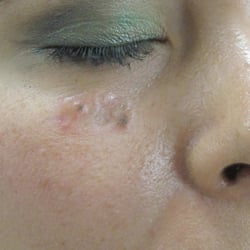 Blepharoplasty Brooklyn Dr Eyal Levit Blepharoplasty Brooklyn Dr Eyal Levit