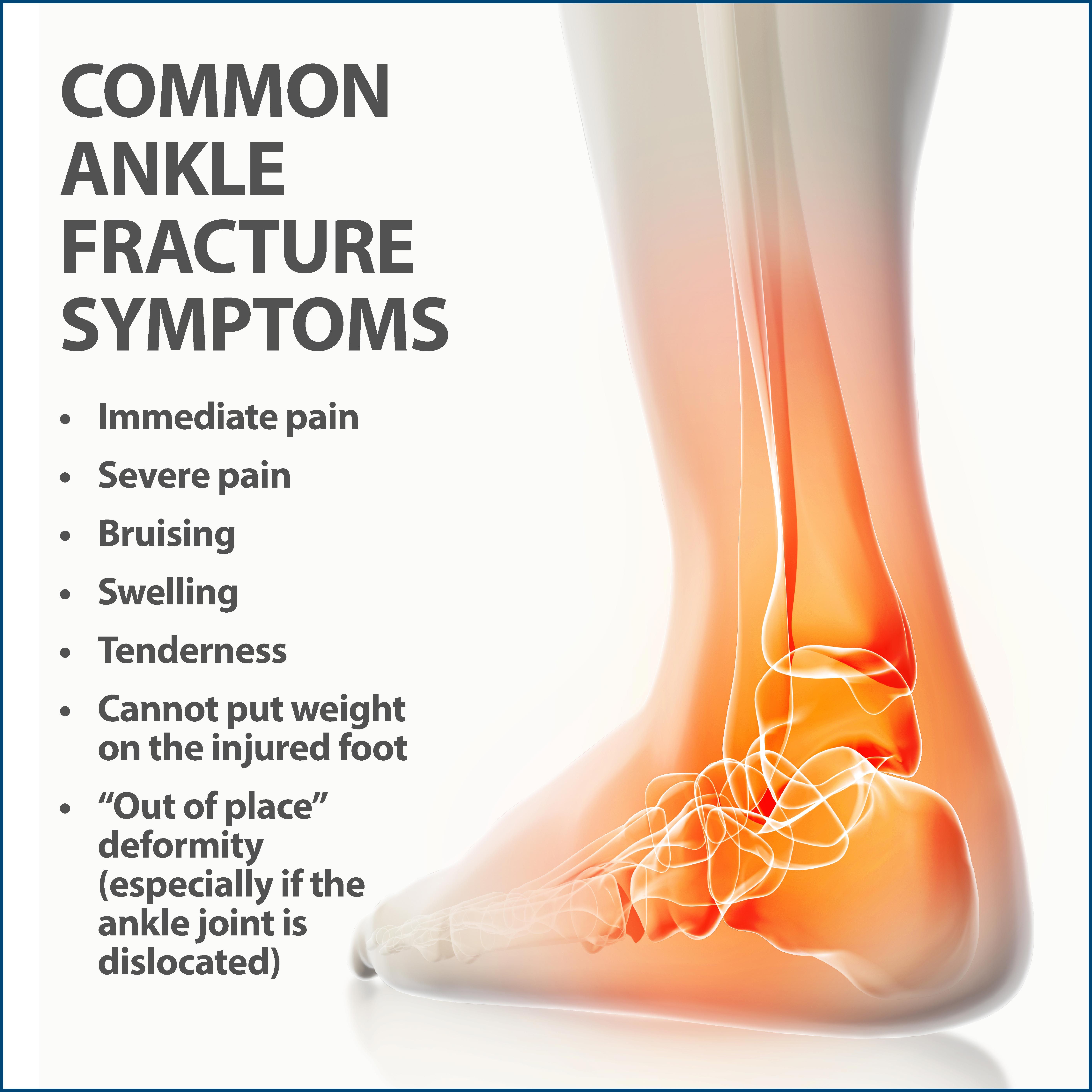 Broken Ankle Guide: Recover In 6 Weeks