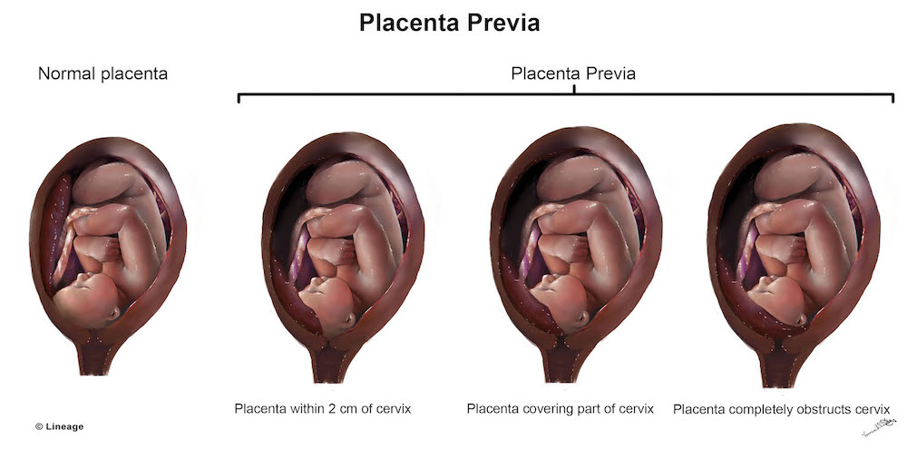 C Section: Safe Delivery With Placenta Previa