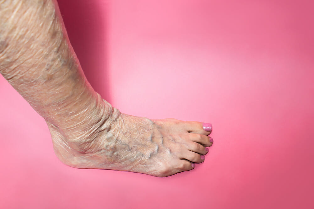 Camol Toe: Fix Unsightly Toes Now