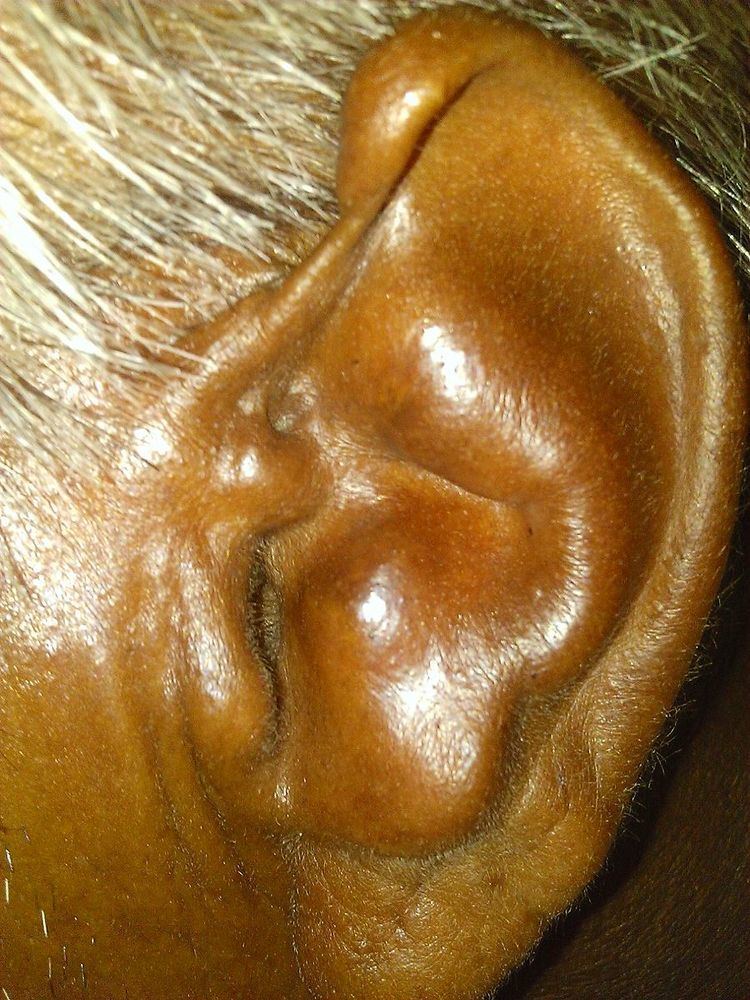 Cauliflower Ear Guide: Understanding The Condition