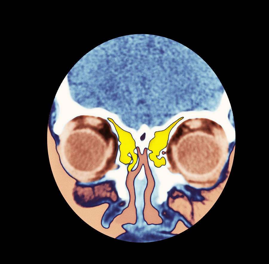 Ct Scan Nose