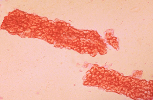 Hyaline Casts In Urine Morphology And Clinical Significance Hyaline Casts In Urine Morphology And Clinical Significance