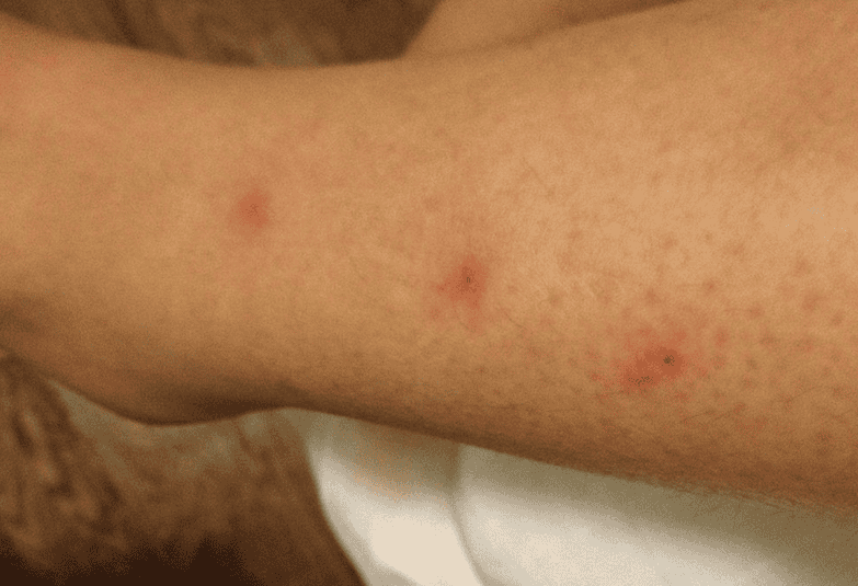 Lady Beetle Bites