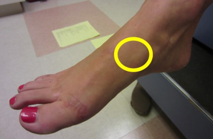 Navicular Fracture Treatment Top Of Foot Stress Fracture Navicular Fracture Treatment Top Of Foot Stress Fracture