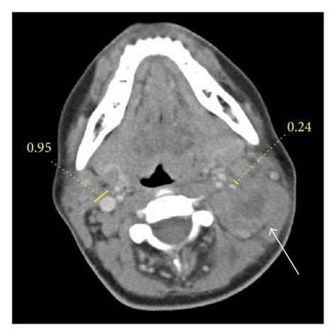 Neck With Contrast Ct Scan