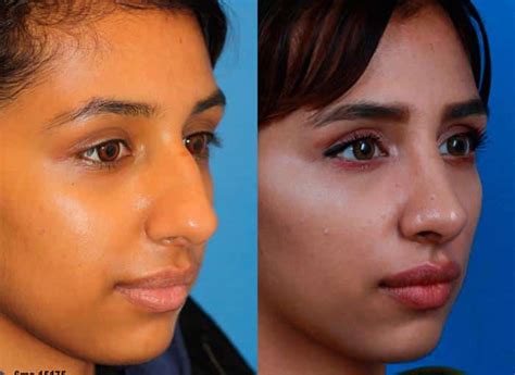 Nose Jobs Nyc