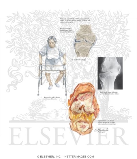 Osteoarthritis Knee Icd 10 Human Anatomy Osteoarthritis Knee Icd 10 Human Anatomy