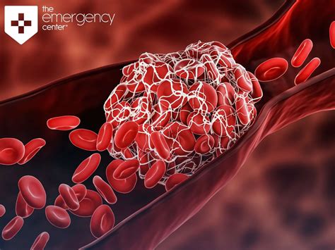 Picture Of A Blood Clot Picture Of A Blood Clot