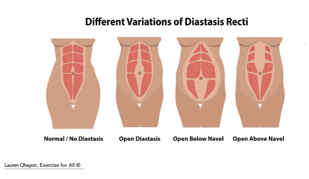 Pictures Of Severe Diastasis Recti