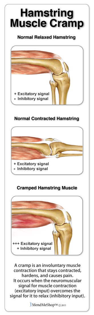 Severe Cramp In Hamstring