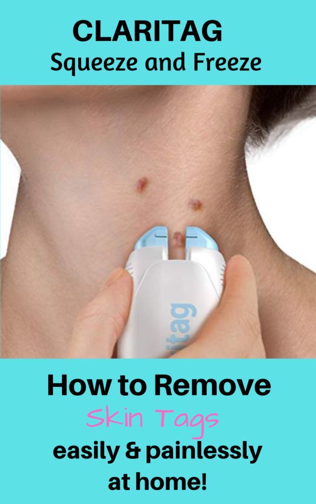 Skin Tag In Ear: Remove Safely At Home