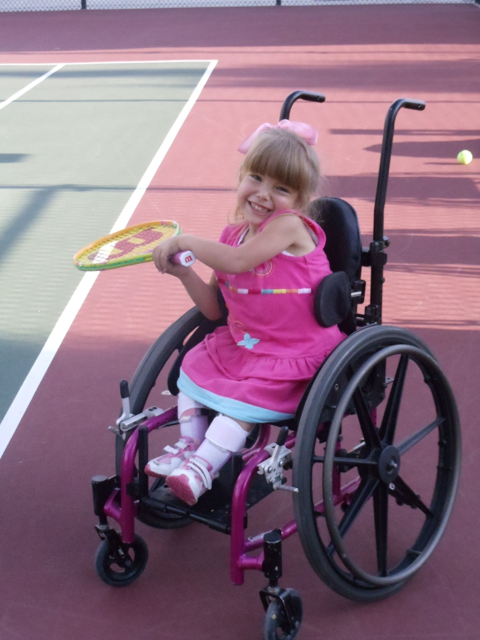 Spina Bifida Life Expectancy: Latest Research