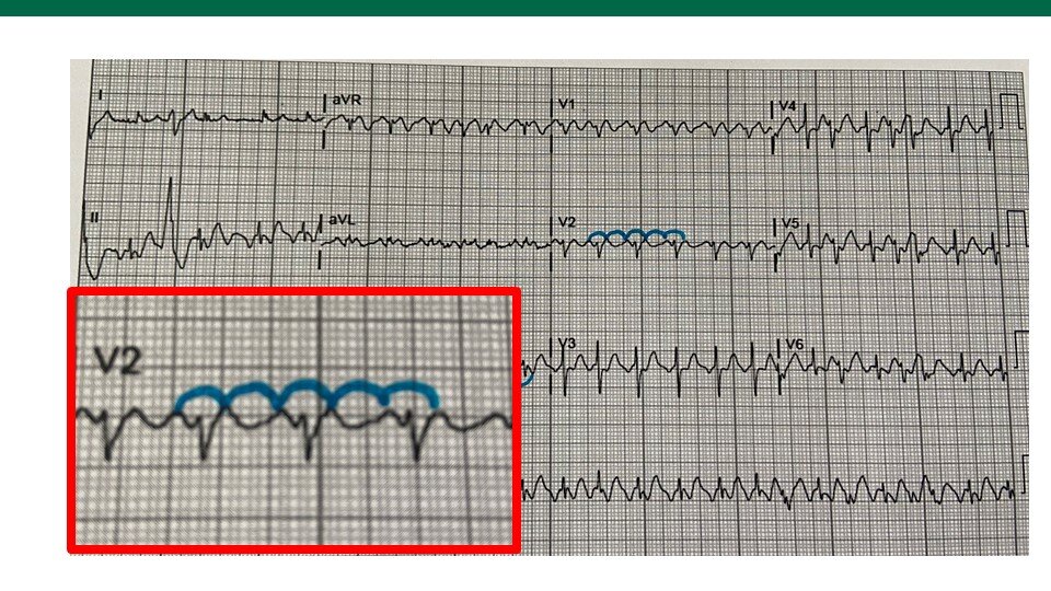 Svt On The Ecg Usf Emergency Medicine