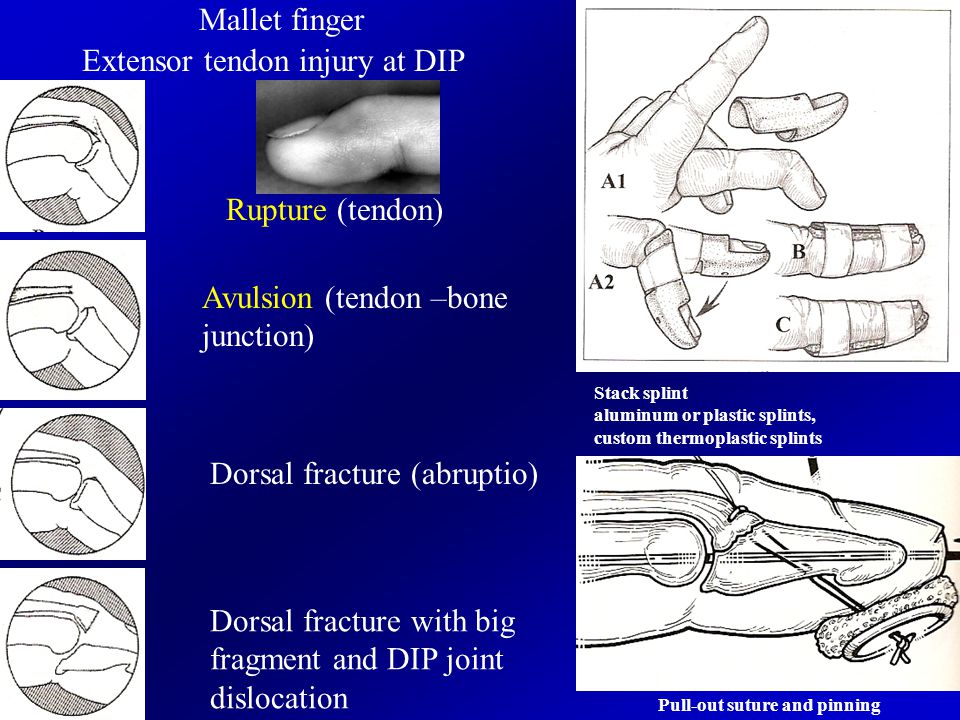 Tendon Rupture And Antibiotics
