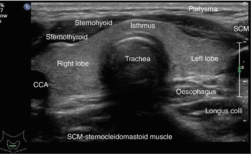 Thyroid Gland Size: Ultrasound Measurement Mastery