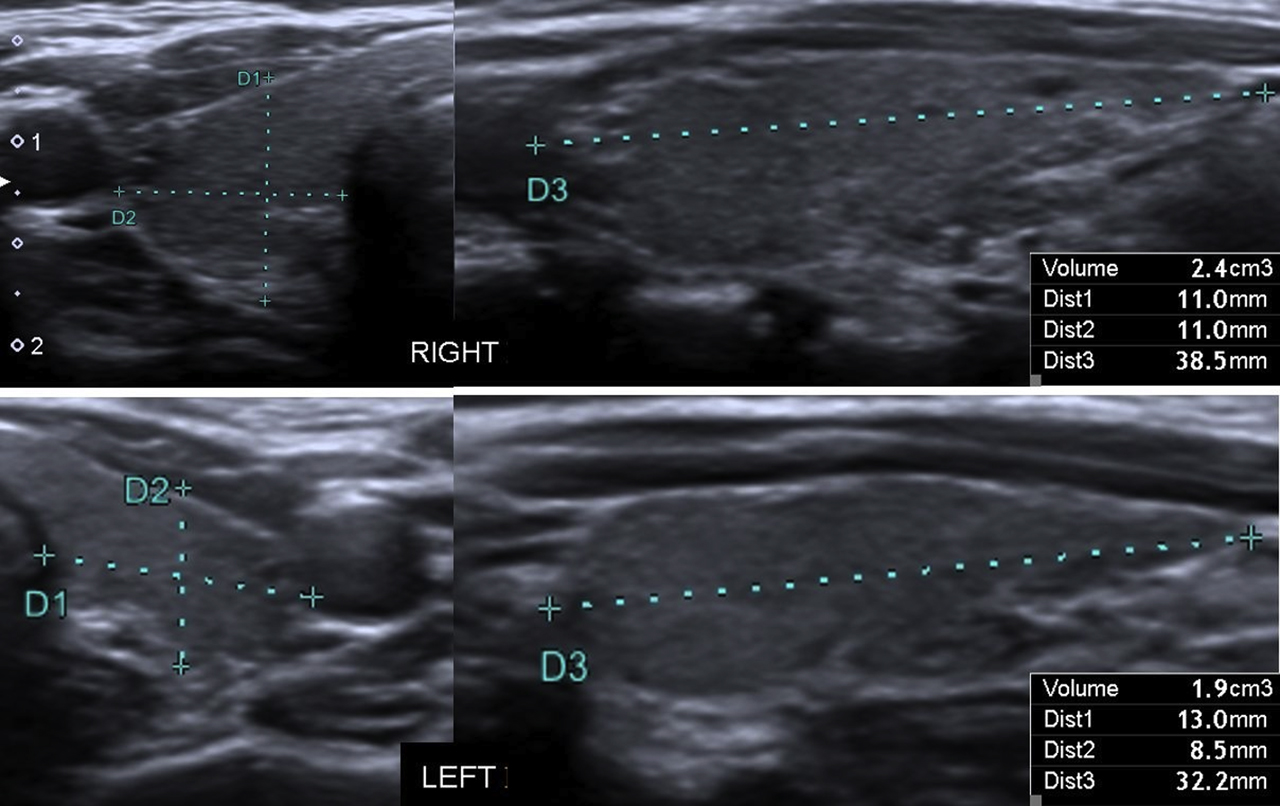 Thyroid Normal Size Ultrasound
