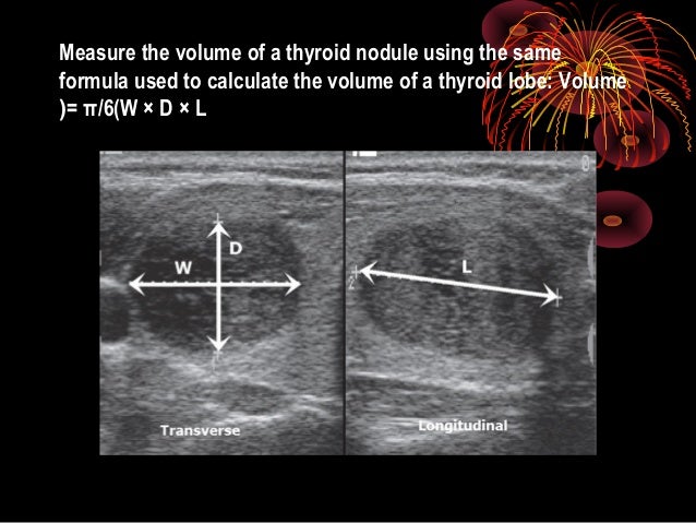 Thyroid Ultrasound Guide: Accurate Measurements