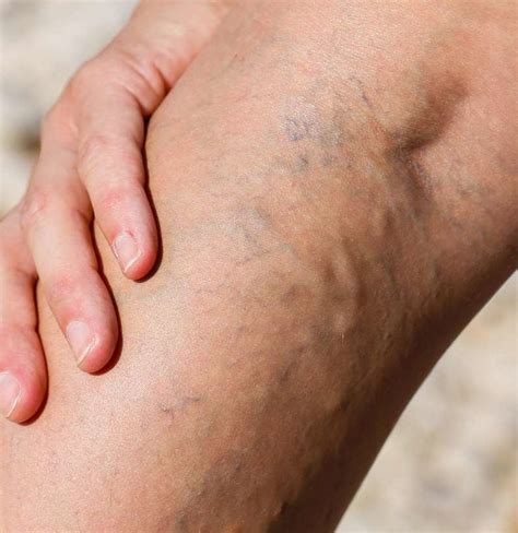 Top 102 Pictures Pictures Of A Blood Clot In The Leg Superb Top 102 Pictures Pictures Of A Blood Clot In The Leg Superb