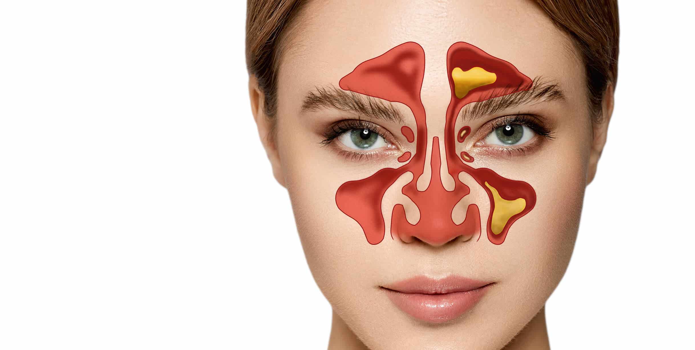 Top 5 Home And Herbal Remedies For Sinusitis Relief Clear Your Nasal Congestion Quickly Youtube Top 5 Home And Herbal Remedies For Sinusitis Relief Clear Your Nasal Congestion Quickly Youtube