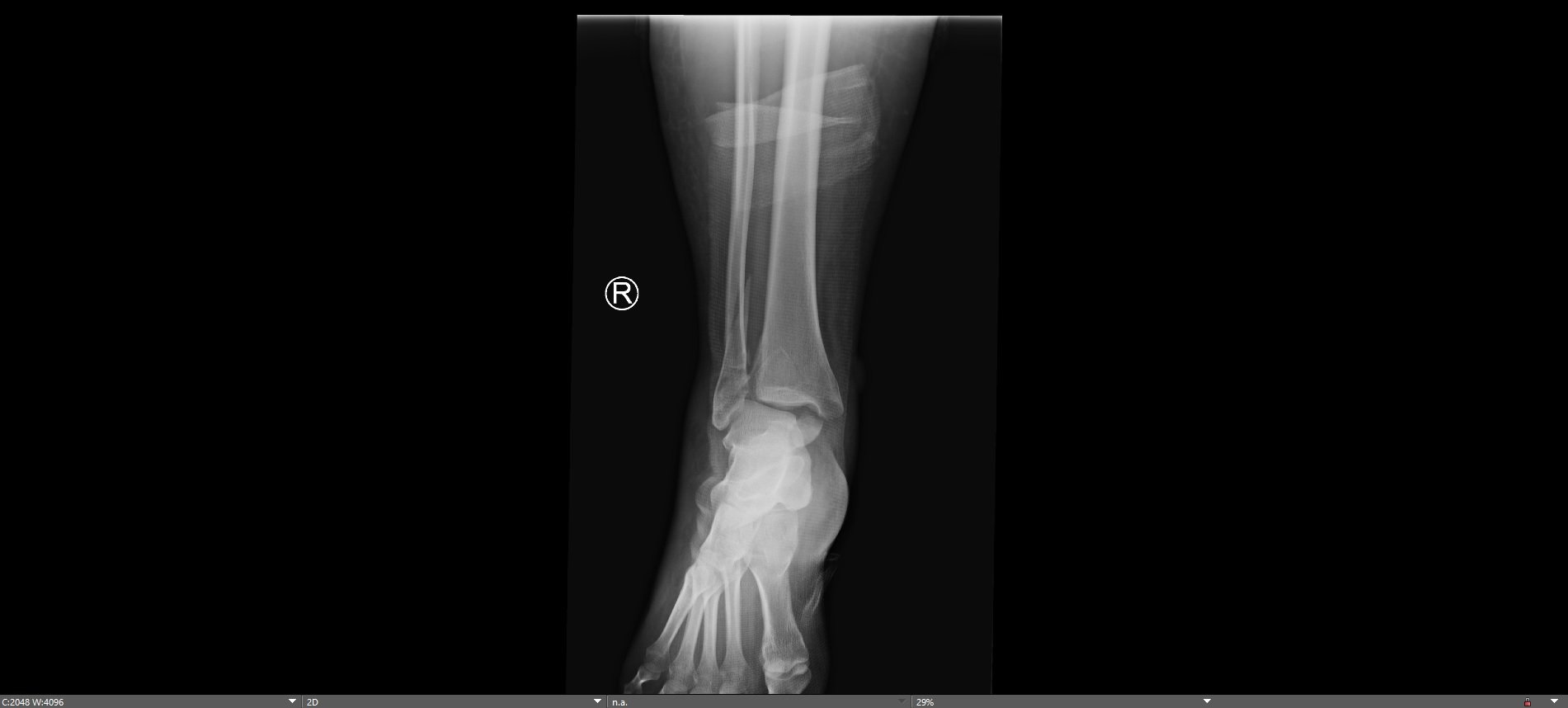 Trimalleolar Ankle Fracture Recovery Trimalleolar Ankle Fracture Recovery
