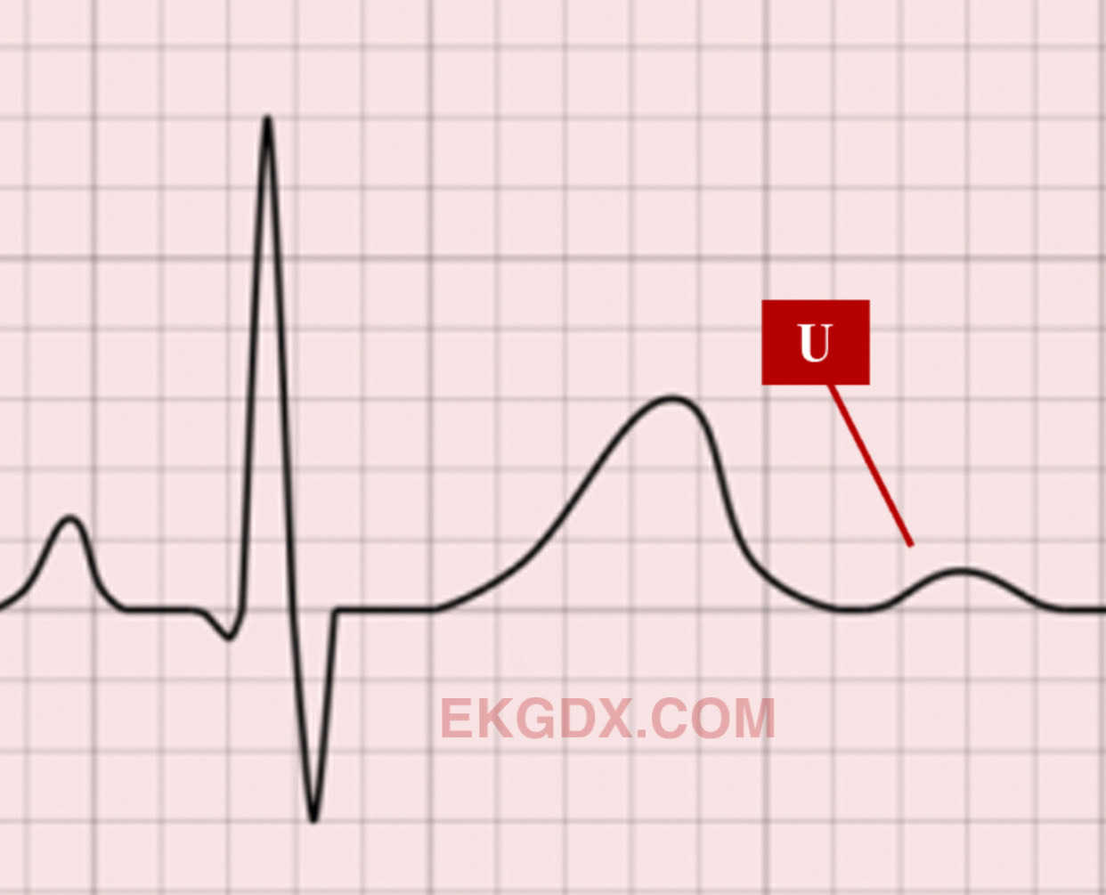 U Waves Ecg: Improve Diagnosis With Expert Insights