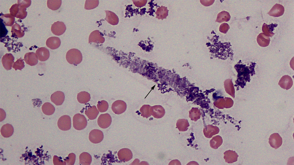 Urine Casts Eclinpath Urine Casts Eclinpath