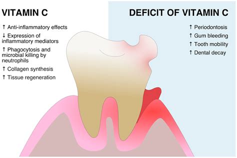 Vitamin C And Gum Disease