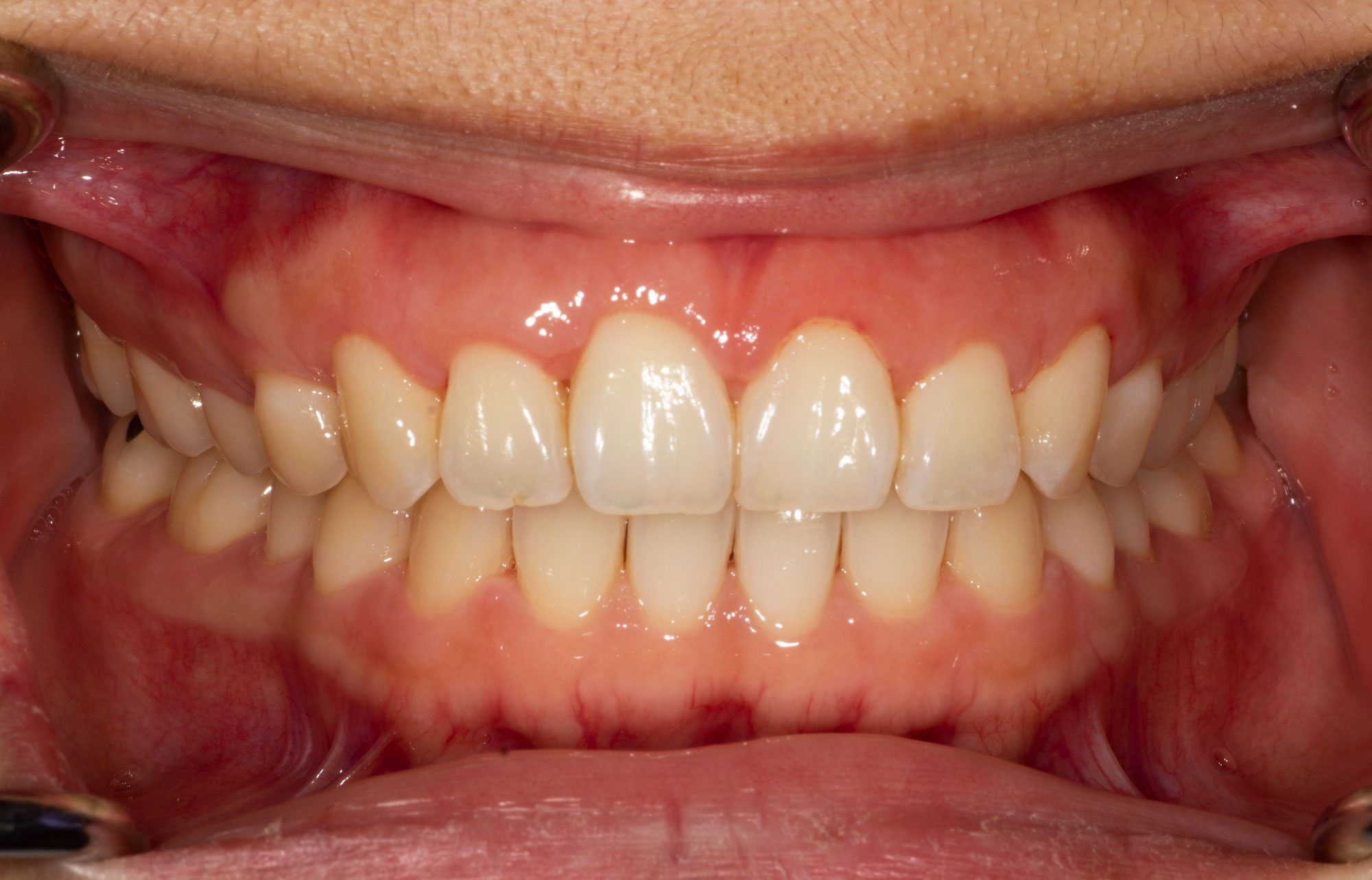 Vitamin C Gum Disease Relief