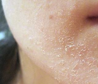 What Causes Dog Black Scaly Skin? Remedies Inside