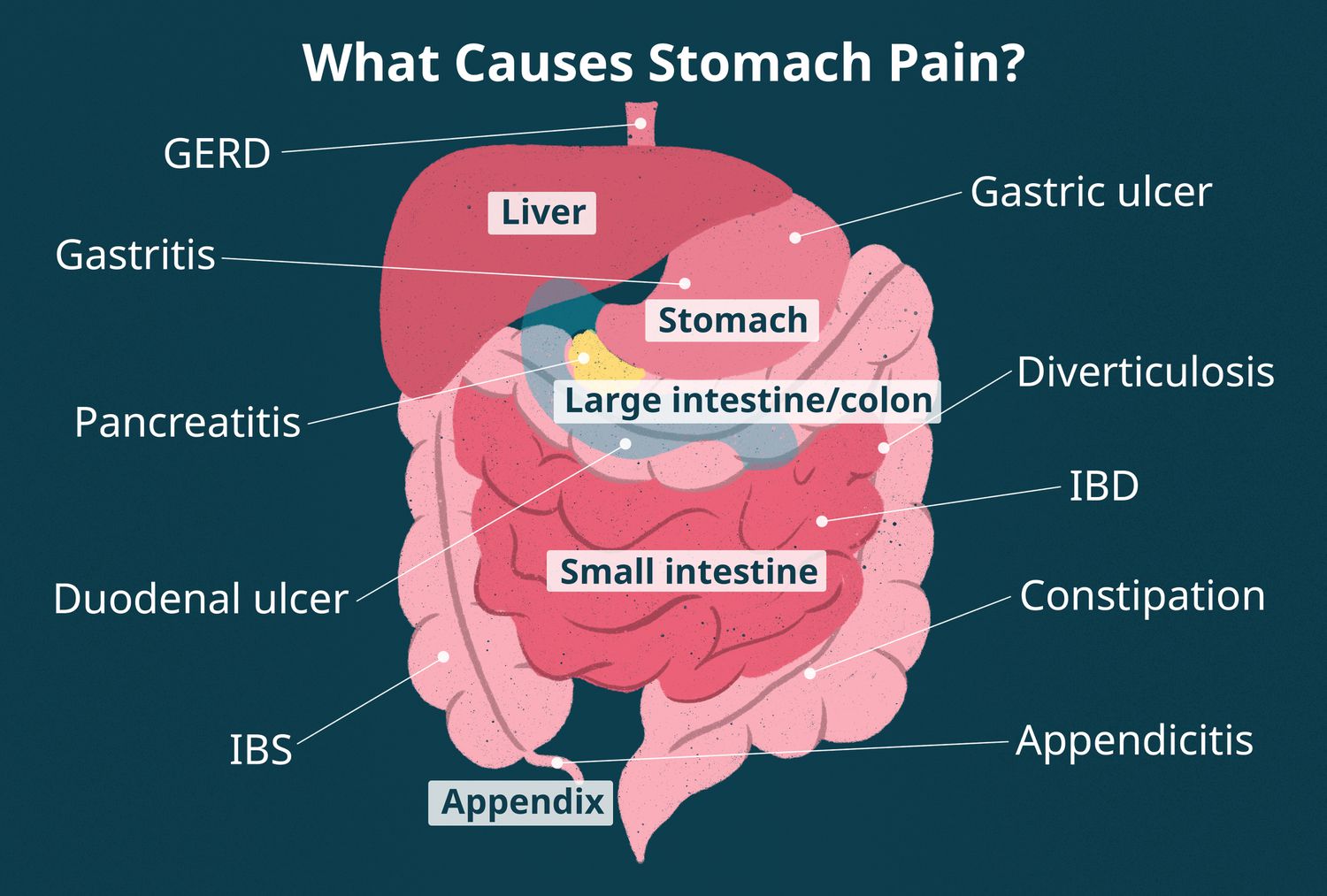 What Causes Stomach Pain When Coughing? Quick Relief