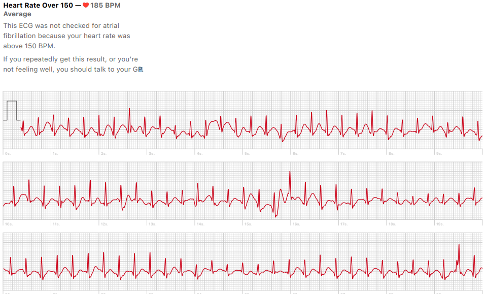 What Is The Difference Between Afib And Svt
